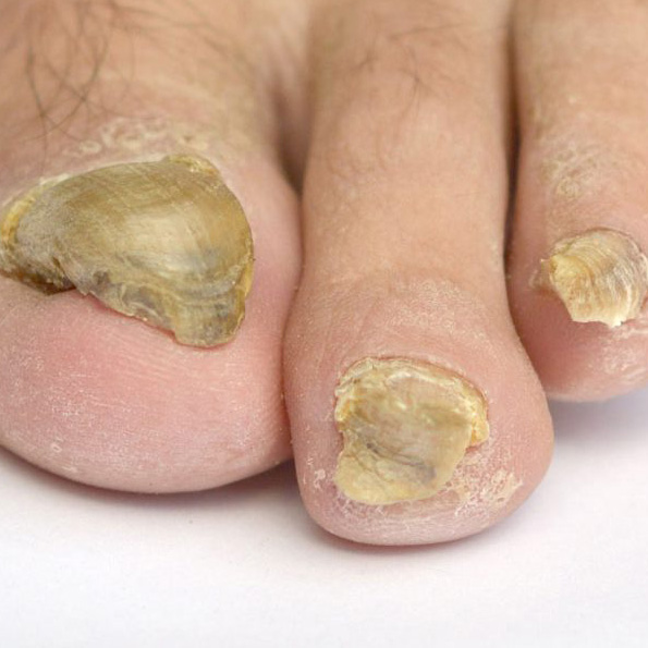 nail fungus kezelési elvek