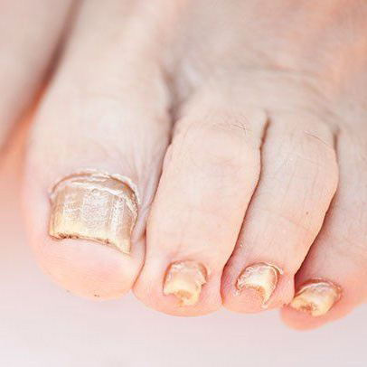 nail fungus kezelési elvek glicerinné kezelésére köröm gomba